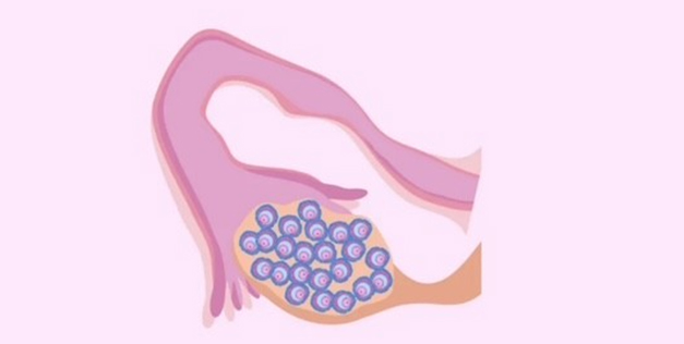 Severe Ovarian Hyperstimulation Syndrome (OHSS) After Gonadotrophin Releasing Hormone Agonist (GnRHa) Triggering